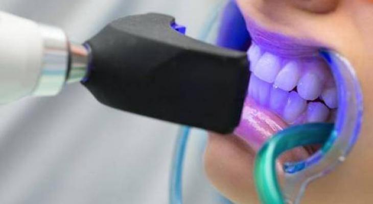  الخطوات الأساسية لعملية تبييض الأسنان بالقوالب