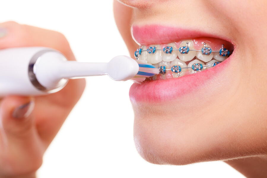 تنظيف تقويم الاسنان بـ 6 طرق سهلة - أسنان كير.كوم